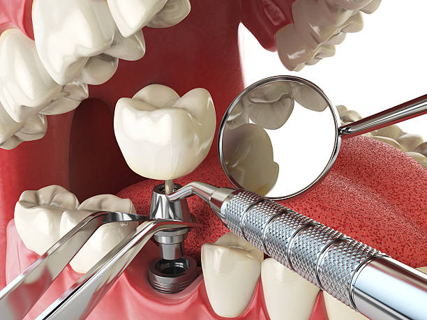Best Knocked-Out Tooth (Avulsed Tooth) Treatment in Bloomingdale, TN