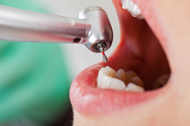 Best Broken or Chipped Tooth Repair in Bloomingdale, TN